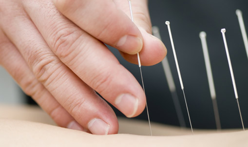 acupuncture-northern-ireland-belfast Acupuncture